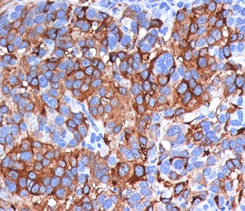 Melan-A Antibody Clone A103 Melanoma IHC. Immunohistochemistry analysis of FFPE human melanoma tissue stained with clone A103. Strong cytoplasmic and membranous HRP-DAB brown staining is observed throughout malignant melanocytic tumor cells, consistent with the expected expression pattern of Melan-A / MLANA/MART-1 in melanoma-associated differentiation and melanosome-related cellular pathways.
