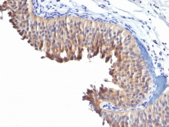 IHC testing of human bladder carcinoma with Cytokeratin 10 antibody (clone LH2). HIER: boil tissue sections in pH 9 10mM Tris with 1mM EDTA for 20 min and allow to cool before testing.