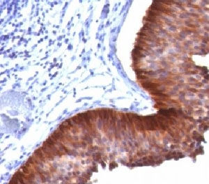 Cytokeratin 17 Antibody Clone E3 immunohistochemistry analysis of human bladder carcinoma tissue. Immunohistochemistry of FFPE human bladder carcinoma demonstrates strong HRP-DAB brown cytoplasmic staining in malignant epithelial cells using Cytokeratin 17 Antibody Clone E3. The staining highlights tumor epithelial cells consistent with the known expression pattern of Cytokeratin 17 (CK17 / KRT17), an epithelial intermediate filament protein commonly detected in stratified epithelial tissues and epithelial-derived tumors. Adjacent stromal cells show minimal staining, supporting epithelial cell-associated expression of CK17 in bladder carcinoma.
