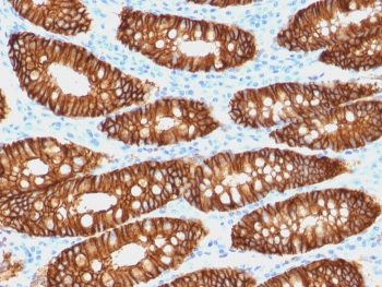 EpCAM Antibody Biotin Conjugate IHC. Immunohistochemistry staining of FFPE human colon carcinoma with biotinylated EpCAM antibody (clone VU-1D9). HIER: boil tissue sections in pH 9 10mM Tris with 1mM EDTA for 20 min and allow to cool before testing.