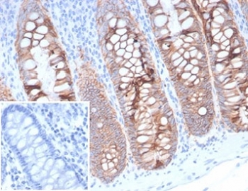 EpCAM Antibody 323/A3 Colon IHC. Immunohistochemistry testing of FFPE human colon tissue with EpCAM antibody (clone 323/A3). Inset: PBS used in place of primary Ab (secondary Ab negative control). HIER: boil tissue sections in pH 9 10mM Tris with 1mM EDTA for 20 min and allow to cool before testing.