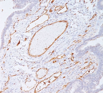 PECAM-1 antibody C31.7 immunohistochemistry colon carcinoma (clone C31.7).