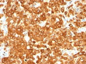 IHC staining of human melanoma with Gp100 Antibody Clone HMB45. HIER: boil tissue sections in pH 9 10mM Tris with 1mM EDTA for 20 min and allow to cool before testing.