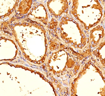 Thyroglobulin Antibody / TG Thyroid Tumor Marker Antibody. Immunohistochemistry analysis of Thyroglobulin using Thyroglobulin antibody (clone 6E1) in FFPE human thyroid tissue section. HRP-DAB brown chromogenic staining highlights strong cytoplasmic signal in thyroid follicular epithelial cells forming well defined follicular structures, with prominent staining of luminal colloid material reflecting abundant secreted Thyroglobulin. The staining pattern supports the use of Thyroglobulin as a thyroid tumor marker and marker of thyroid follicular epithelial differentiation, commonly used to identify thyroid-derived tumors and evaluate thyroid carcinoma biology.