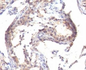 IHC testing of FFPE human testicular carcinoma with TGF alpha antibody (clone MF9)
