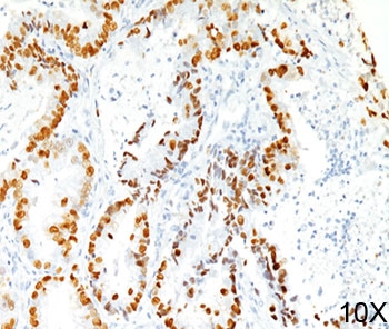 TTF-1 Antibody Clone 8G7G3/1 Lung Adenocarcinoma IHC. Human lung adenocarcinoma stained using TTF-1 Antibody Clone 8G7G3/1 demonstrates strong nuclear immunoreactivity for Thyroid transcription factor 1 (NKX2-1) in malignant pulmonary epithelial cells. Nuclear staining highlights tumor cells of pulmonary epithelial origin and reflects the well-established use of clone 8G7G3/1 antibody as a diagnostic immunohistochemistry marker for pulmonary adenocarcinoma. TTF-1 expression in tumor cell nuclei assists pathologists in identifying lung adenocarcinoma and distinguishing primary pulmonary carcinoma from metastatic tumors involving the lung.