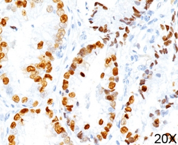 TTF-1 Antibody Clone 8G7G3/1 Human Lung Adenocarcinoma Tissue IHC. Human lung adenocarcinoma stained using TTF-1 Antibody Clone 8G7G3/1 shows strong nuclear staining for Thyroid transcription factor 1 (NKX2-1) in malignant pulmonary epithelial cells. Nuclear immunoreactivity highlights pulmonary epithelial tumor cells and reflects the diagnostic role of clone 8G7G3/1 antibody in immunohistochemistry panels used for lung adenocarcinoma evaluation. Detection of nuclear NKX2-1 expression supports pulmonary epithelial lineage and helps distinguish primary lung carcinoma from metastatic malignancies.