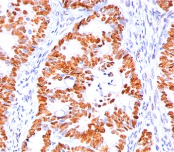 p53 Antibody Clone BP53-12 / TP53 Tumor Suppressor Antibody. Immunohistochemistry analysis of FFPE human colon carcinoma tissue demonstrates strong nuclear staining of tumor epithelial cells using p53 Antibody Clone BP53-12. The HRP-DAB brown chromogenic signal highlights nuclear localization of Tumor protein p53 within malignant epithelial cells, while surrounding stromal and non-neoplastic cells show comparatively weaker staining. The staining pattern is consistent with nuclear accumulation of TP53 commonly observed in colorectal carcinoma.