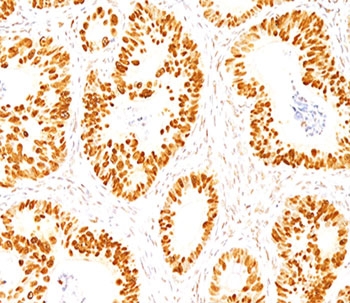 p53 Antibody Clone DO-7 / TP53 Tumor Suppressor Antibody. Immunohistochemistry analysis of FFPE normal human colon tissue demonstrates nuclear staining of epithelial cells using p53 Antibody Clone DO-7. The HRP-DAB brown chromogenic signal highlights nuclear localization of Tumor protein p53 within glandular epithelial cells of the colonic mucosa, while surrounding stromal cells show comparatively weaker staining. The staining pattern is consistent with nuclear localization of TP53 in epithelial cells of normal colon tissue.