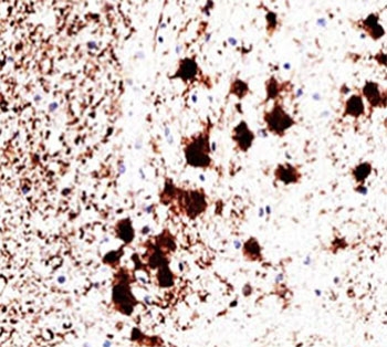 PGP9.5 Antibody Clone 31A3 for IHC. Immunohistochemistry analysis of PGP9.5 / UCHL1 in human brain tissue. Formalin-fixed, paraffin-embedded human brain tissue stained with PGP9.5 Antibody for IHC, also known as UCHL1 antibody or Ubiquitin C-terminal hydrolase L1 antibody, demonstrates strong cytoplasmic and neuritic HRP-DAB brown staining in neuronal cells, with clear labeling of neuronal cell bodies and processes while surrounding non-neuronal cells show minimal signal. Clone 31A3 antibody shows a well-defined neuronal staining pattern consistent with published observations, supporting its use as a widely cited and trusted reagent for detecting UCHL1 expression in neural tissue. Antigen retrieval was performed by heating sections in pH 9 Tris-EDTA buffer at 95oC for 45 minutes followed by cooling at room temperature for 20 minutes.