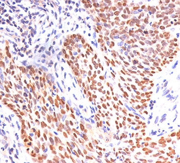 p40 Antibody IHC. Immunohistochemistry analysis of FFPE human lung squamous cell carcinoma tissue demonstrates strong HRP-DAB brown nuclear staining in tumor cell populations, while surrounding stromal cells remain largely negative. The nuclear-restricted staining pattern highlights epithelial cells with basal-like characteristics and supports use of this antibody as a basal progenitor cell maintenance marker, reflecting deltaNp63-driven transcriptional programs associated with proliferative epithelial compartments. Staining is intense and well-defined, allowing clear distinction between p40-positive tumor regions and adjacent negative tissue. Heat-induced epitope retrieval was performed using pH 9 10mM Tris with 1mM EDTA buffer.