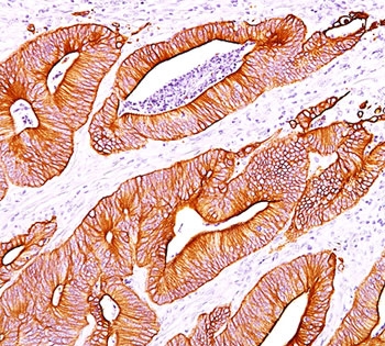 Pan Cytokeratin Antibody colon carcinoma IHC. Immunohistochemistry analysis of cytokeratin expression in FFPE human colon carcinoma using Pan Cytokeratin antibody clone AE1/AE3. Strong cytoplasmic HRP-DAB brown staining highlights malignant epithelial cells forming glandular tumor structures, with clear delineation of carcinoma architecture against surrounding stromal tissue. The staining pattern supports epithelial lineage identification and is consistent with broad cytokeratin expression in carcinoma cells.