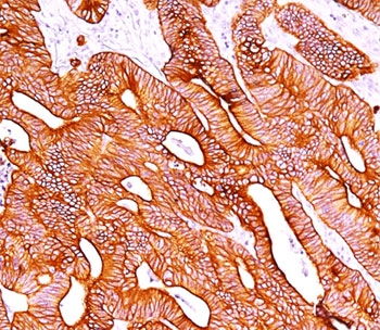 Pan Cytokeratin Antibody AE1/AE3 colon carcinoma IHC. Immunohistochemistry analysis of cytokeratin expression in FFPE human colon carcinoma using Pan Cytokeratin antibody clone AE1/AE3. Strong cytoplasmic HRP-DAB brown staining highlights malignant epithelial cells forming glandular tumor structures, with clear delineation of carcinoma architecture against surrounding stromal tissue. The staining pattern supports epithelial lineage identification and is consistent with broad cytokeratin expression in carcinoma cells.