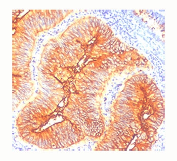 IHC staining of human colon cancer with TAG-72 antibody (clone CA72/733).