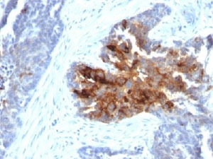 TAG-72 Antibody Cocktail Ovarian Carcinoma Immunohistochemistry. IHC staining of human prostate carcinoma with TAG-72 antibody cocktail (B72.3 + CA72/733).