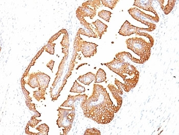 Immunohistochemistry of PSA / Prostate Specific Antigen in human prostate carcinoma. Formalin-fixed, paraffin-embedded human prostate carcinoma tissue stained with PSA/Prostate Specific Antigen antibody (clone KLK3/801) shows strong cytoplasmic and luminal staining in malignant prostate epithelial cells forming glandular structures, with minimal staining in surrounding stromal cells. Antigen retrieval was performed by boiling tissue sections in 10 mM citrate buffer, pH 6.0, for 10-20 minutes, followed by cooling at room temperature for 20 minutes.