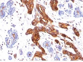 Formalin-fixed, paraffin-embedded human breast carcinoma stained with EMA antibody (MUC1/845).