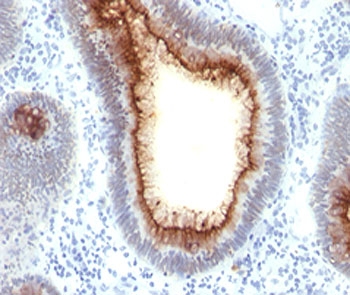 Immunohistochemistry of CEA antibody in human colon carcinoma tissue. FFPE human colon carcinoma demonstrates strong membranous and apical HRP-DAB brown staining in tumor epithelial cells lining glandular structures, consistent with Carcinoembryonic antigen / CEACAM5 localization at the cell surface. Clone C66/1009 was used as a mouse monoclonal antibody for detection.