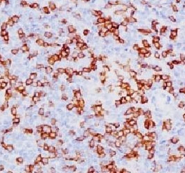 CD8A Antibody Human Tonsil IHC. Immunohistochemistry analysis of CD8 alpha (CD8A) in FFPE human tonsil tissue shows membranous staining of cytotoxic T lymphocytes within lymphoid regions, consistent with CD8-positive cells mediating antigen-specific immune responses and supporting detection of this adaptive immunity marker in secondary lymphoid tissue (clone SPM548).