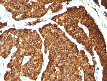 Chromogranin A Antibody Pheochromocytoma IHC. Immunohistochemistry staining of formalin-paraffin human pheochromocytoma with Chromogranin A antibody (clone CHGA/777).
