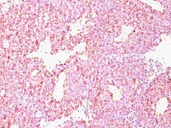 Chromogranin A Antibody SC Lung Carcinoma IHC. Immunohistochemistry staining of formalin-paraffin human SC lung carcinoma with Chromogranin A antibody (clone CHGA/798).