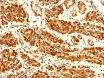 Calponin 1 Antibody Uterus IHC. Immunohistochemistry analysis of FFPE human uterus tissue using Calponin 1 antibody. The mouse monoclonal antibody clone CNN1/832 shows strong HRP-DAB brown cytoplasmic staining in smooth muscle cells of the myometrium, with signal distributed along contractile fibers consistent with Calponin 1 / CNN1 expression. Non-smooth muscle components display minimal background staining, supporting the specificity of this marker for smooth muscle lineage cells.