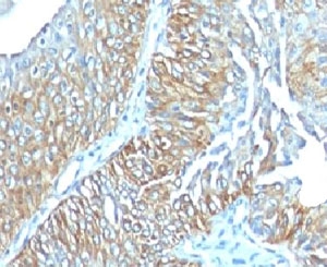 TRIM29 Antibody Mouse Monoclonal Esophageal Carcinoma Immunohistochemistry. IHC: Formalin-fixed, paraffin-embedded human esophageal carcinoma stained with mouse monoclonal TRIM29 antibody (clone TRIM29/1041).