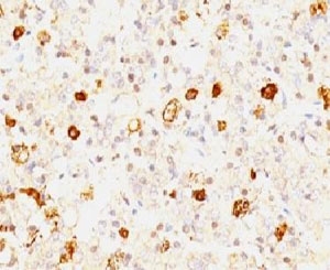 FSHB Antibody Anterior Pituitary IHC. Immunohistochemistry staining of formalin-fixed, paraffin-embedded human pituitary tissue using monoclonal clone FSHb/1062 demonstrates distinct granular cytoplasmic HRP-DAB brown staining in scattered hormone-producing anterior pituitary endocrine cells, consistent with follicle stimulating hormone beta / FSHB expression in gonadotroph-associated cellular populations.