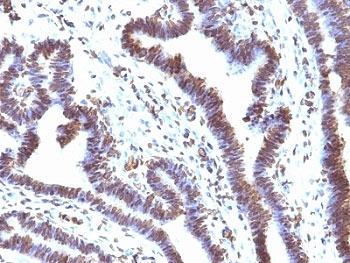 EMI1 Antibody Ovarian Carcinoma IHC. Immunohistochemistry analysis of formalin-fixed, paraffin-embedded human ovarian carcinoma tissue stained with EMI1 Antibody / Cell Cycle Checkpoint Regulator Antibody clone EMI1/1176 demonstrates prominent nuclear HRP-DAB brown staining throughout malignant epithelial cell populations, consistent with the role of Early mitotic inhibitor 1 / FBXO5 in proliferative signaling, APC/C-associated checkpoint regulation, and mitotic progression control. The predominantly nuclear staining pattern aligns with the function of EMI1 as a cell cycle regulatory protein involved in maintenance of orderly cell cycle progression and genomic stability.