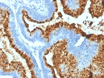 Blood Group Antigen B Antibody Colon Carcinoma IHC. Immunohistochemistry analysis of Blood Group Antigen B expression in FFPE human colon carcinoma tissue using Blood Group Antigen B Antibody / Blood Typing Marker clone HEB-20. Strong HRP-DAB brown membranous and apical staining is observed throughout neoplastic epithelial cell populations, highlighting preservation of blood group B associated carbohydrate determinants on the tumor cell surface. Surrounding stromal elements are largely negative, producing a distinct contrast between antigen-positive epithelial structures and the supporting tumor microenvironment. Blood group B antigens are carbohydrate epitopes carried on glycolipids and glycoproteins that contribute to ABO blood group classification and epithelial cell surface glycosylation patterns. Clone HEB-20 demonstrates robust detection of Blood Group Antigen B in human colon carcinoma tissue. Hematoxylin counterstain (blue).