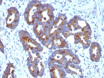 ABO Antibody Colorectal Carcinoma IHC. Immunohistochemistry staining of FFPE human colorectal carcinoma tissue using ABO Antibody demonstrates distinct membranous and apical HRP-DAB brown staining within gland-forming epithelial tumor cells. The staining pattern is consistent with expression of A and H chain carbohydrate antigens, cell surface glycan structures associated with the ABO blood group system. Clone HE-10 highlights carbohydrate epitope expression on neoplastic epithelial cells and supports the utility of this chain-selective antibody for studies of blood group antigen distribution, glycobiology, and tissue-specific glycosylation patterns. The observed staining is consistent with expression of ABO-associated carbohydrate determinants on epithelial-derived tumor tissues.
