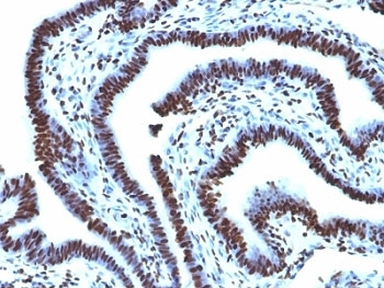 Histone H1 Antibody for IHC. Immunohistochemistry analysis of total histone H1 expression in FFPE human ovarian carcinoma tissue using Histone H1 Antibody. Nuclear HRP-DAB brown staining is observed in tumor epithelial cells, consistent with localization of linker histone H1 within chromatin and its role in higher-order chromatin organization. Clone AE-4 antibody demonstrates strong nuclear compartmentalization with minimal cytoplasmic staining, reflecting the chromatin-associated distribution of histone H1.