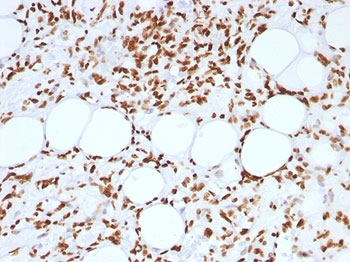IHC: FFPE human angiosarcoma tested with Histone H1 antibody (clone AE-4).