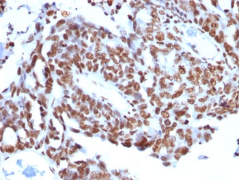 Histone H1 Antibody for IHC. Immunohistochemistry analysis of chromatin condensation-associated histone H1 expression in FFPE human ovarian carcinoma tissue using Histone H1 Antibody. Nuclear HRP-DAB brown staining is observed in tumor epithelial cells, consistent with localization of linker histone H1 within condensed chromatin and its role in higher-order chromatin organization. Clone SPM256 antibody highlights strong nuclear compartmentalization with minimal cytoplasmic staining, reflecting chromatin-associated distribution in condensed chromatin states.