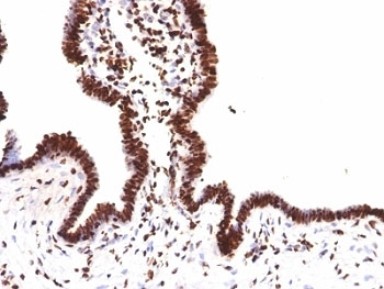 Histone H1 Antibody for IHC. Immunohistochemistry analysis of histone H1 variant family expression in FFPE human ovarian carcinoma tissue using Histone H1 Antibody. Nuclear HRP-DAB brown staining is observed in tumor epithelial cells, consistent with localization of linker histone H1 isoforms within chromatin and reflecting variant-associated chromatin organization. Clone HH1/957 antibody demonstrates strong nuclear compartmentalization with minimal cytoplasmic staining, highlighting broad detection of H1 family proteins across chromatin.