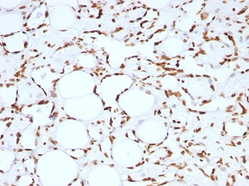 IHC: FFPE human angiosarcoma tested with Histone H1 antibody (clone HH1/957).