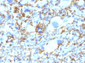 Formalin-fixed, paraffin-embedded human Histiocytoma stained with HLA-DRB1 antibody (clone SPM423).