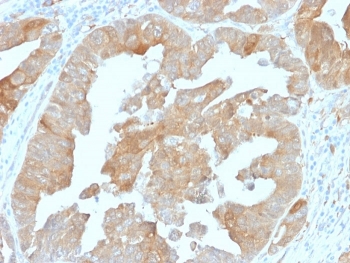 IHC: Formalin-fixed, paraffin-embedded human prostate carcinoma stained with IDH1 antibody (clone IDH1/1152).