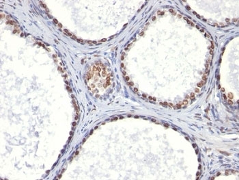 AR Antibody Clone AR441 immunohistochemistry of human prostate carcinoma. Formalin-fixed, paraffin-embedded human prostate carcinoma tissue stained with AR Antibody Clone AR441 shows strong nuclear HRP-DAB brown chromogenic staining in tumor epithelial cells, consistent with androgen receptor expression and the expected nuclear localization of this ligand-activated transcription factor. Surrounding stromal elements display minimal staining, highlighting the epithelial predominance of AR-positive cells in prostate carcinoma.