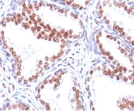 Androgen Receptor Antibody Clone SPM335 immunohistochemistry of human prostate carcinoma. Formalin-fixed, paraffin-embedded human prostate carcinoma tissue stained with Androgen Receptor Antibody Clone SPM335 shows strong nuclear HRP-DAB brown chromogenic staining in tumor epithelial cells, consistent with androgen receptor expression and the expected nuclear localization of this ligand-activated steroid hormone receptor. Surrounding stromal cells demonstrate minimal staining, highlighting the epithelial predominance of AR-positive tumor cells within the carcinoma tissue.