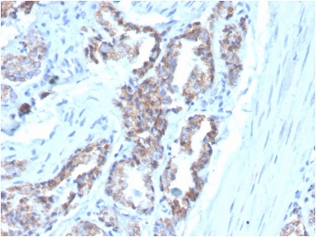 IHC staining of FFPE human prostate carcinoma with Cytokeratin 7 antibody (clone OV-TL12/30). HIER: boil tissue sections in pH 9 10mM Tris with 1mM EDTA for 20 min and allow to cool before testing.