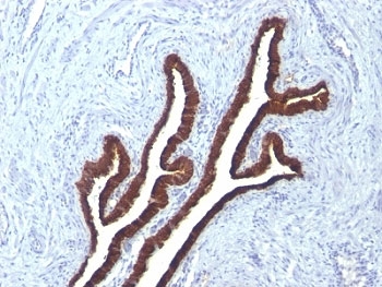 IHC: Formalin-fixed, paraffin-embedded human ovarian carcinoma stained with Keratin 7 antibody (KRT7/760 + KRT7/903)