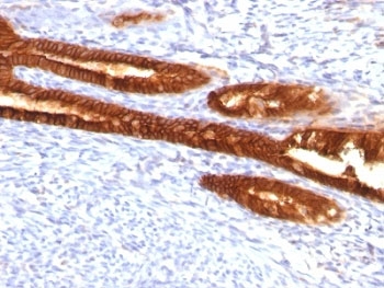 IHC: Formalin-fixed, paraffin-embedded human endometrial carcinoma stained with Keratin 7 antibody (KRT7/760 + KRT7/903)