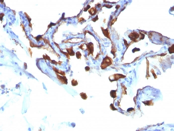 Keratin 8 Antibody Lung Carcinoma Tissue IHC. Immunohistochemical analysis of FFPE human lung carcinoma tissue using Keratin 8 Antibody (clone KRT8/803) demonstrates strong cytoplasmic and membranous HRP-DAB brown staining within malignant epithelial cells. The staining pattern is consistent with expression of Cytokeratin 8 (KRT8), a type II intermediate filament protein commonly expressed in simple epithelial tissues and epithelial-derived malignancies. Cytokeratin 8 positivity highlights tumor-associated epithelial structures and supports assessment of epithelial differentiation in lung carcinoma specimens.