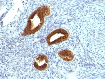 IHC: Formalin-fixed, paraffin-embedded human endometrial carcinoma stained with Cytokeratin 19 antibody (KRT19/799).