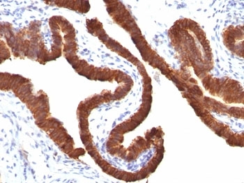 IHC: Formalin-fixed, paraffin-embedded human ovarian carcinoma stained with Cytokeratin 19 antibody (KRT19/799).