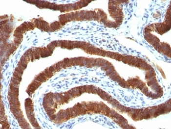 IHC: Formalin-fixed, paraffin-embedded human ovarian carcinoma stained with KRT19 Ab (clone Ks19.1).