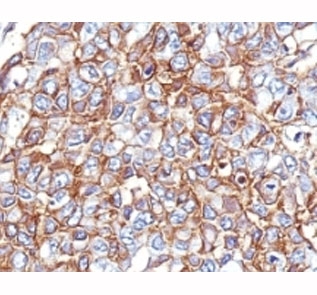 IHC: Formalin-fixed, paraffin-embedded human breast carcinoma stained with EpCAM antibody cocktail (PAN-EpCAM).