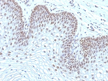 IHC: Formalin-fixed, paraffin-embedded human cervical carcinoma stained with MAP3K1 antibody (2F6).