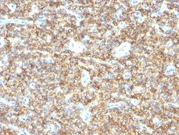IHC: Formalin-fixed, paraffin-embedded human Ewing's sarcoma stained with CD99 antibody (HO36-1.1).